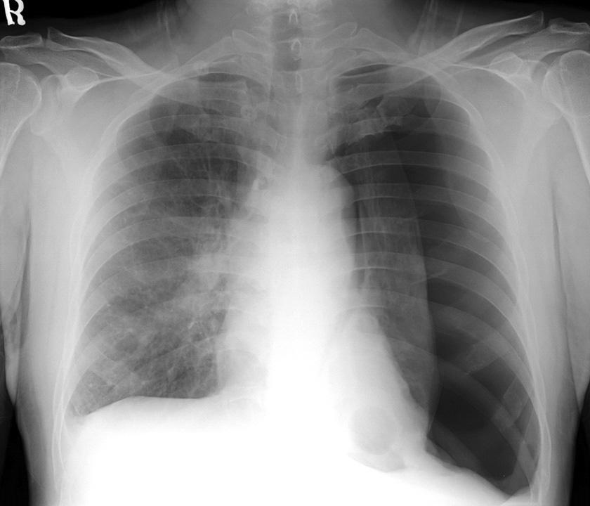CJ Lee et al: Cystic lung metastasis of angiosarcoma Figure 3. On admission, Chest X-ray showed left pneumothorax.