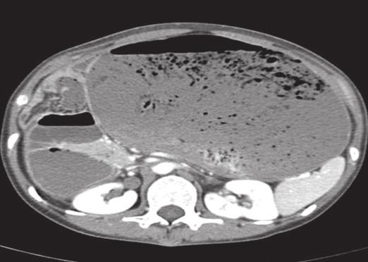 Both pictures showed the dilated small bowel at the right upper quadrant and large food material of the stomach. Figure 2.