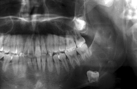 %) 7 (9.%) 86 (00%) Impacted tooth Containing Non Unknown Number 0 (54.8%) 8 (44.%) (.%) 86 (00%) Nobuyoshi Tomomatsu et al:. J Korean Assoc Oral Maxillofac Surg 0 Table 5.