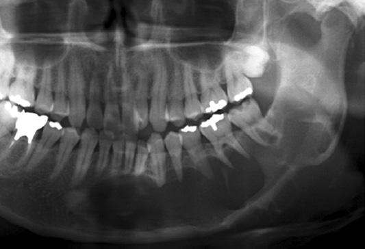 the bone) 7 incidentally by x-ray examination) 9 Soft tissue 9 Nobuyoshi Tomomatsu et al:. J Korean Assoc Oral Maxillofac Surg 0 종창 4 증례, 동통 증례, 위화감 증례, 기타 증례에대해 서는증상없이경과관찰중에 X 선사진에서발견된것이 대부분이었다.