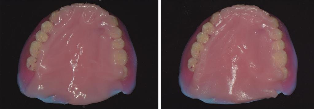 Case of making maxillary palatal augmentation complete denture for patient with dysphagia after