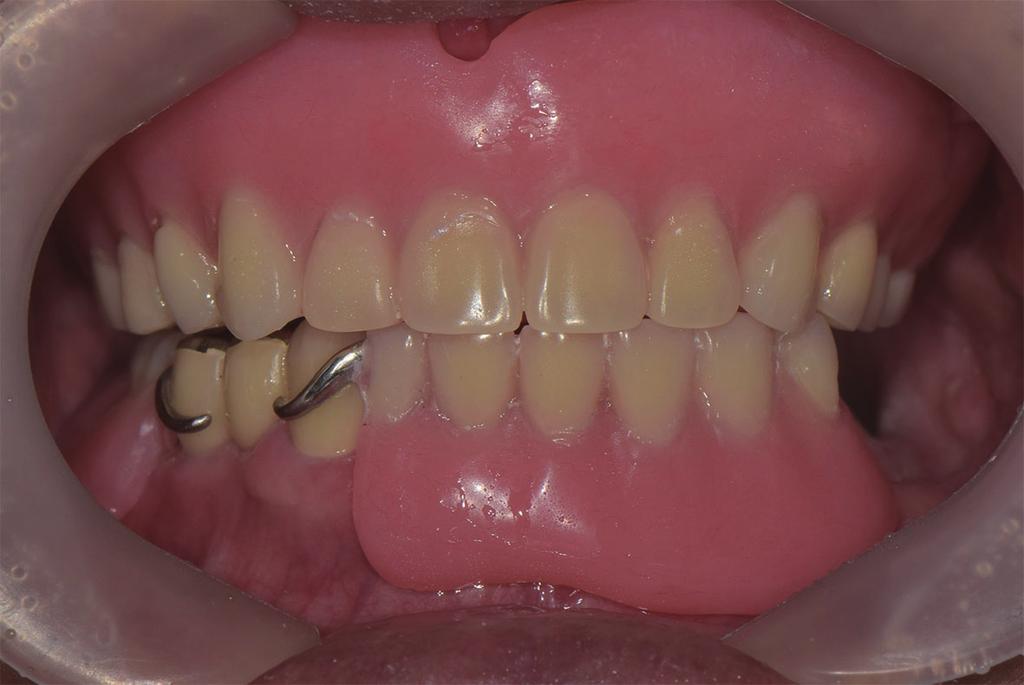 (A) Upper wax denture after trimming tissue conditioner, (B, C) Occlusal & rear view of cured upper
