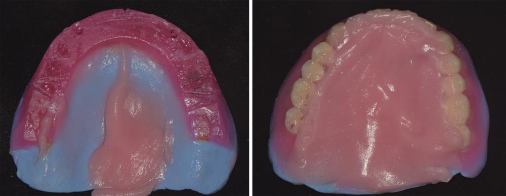 Case of making maxillary palatal augmentation complete denture for patient with dysphagia after partial glossectomy A B Fig. 8. Upper wax denture after polished surface impression.
