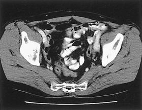 from right ovary. (B) Follow CT scan of 5year after treatment revealed no evidence of disease. Figure 2.