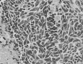 -Jin Young Kim, et al : Small cell carcinoma of the ovary - Figure 4. The tumor cells have scanty cytoplasm and hyperchromatic nuclei with stippled chromatin and inconspicuous nucleoli.