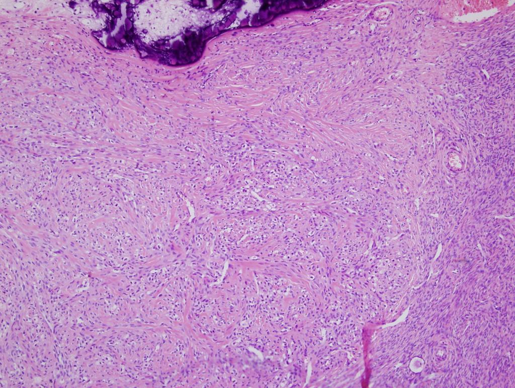 (D) Low power view of case 3 demonstrates typical pseudolobular pattern of cellular area and loose edematous stromal portion (H&E stain, 40). 증례 3 되지 않았다.