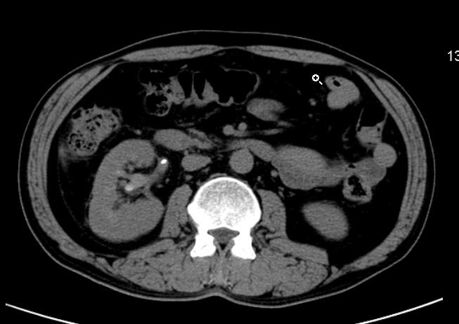 김철성 : 요로결석환자에서발생한전신적칸디다증 83 A B Fig. 1. CT scan of abdomen shows mild hydronephrosis and a small stone in right ureteropelvic junction.