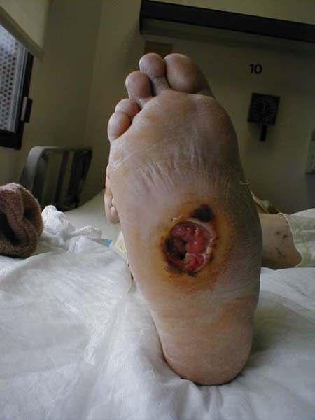 Neuropathic Ulcer: Charcot foot deformity. Large painless ulcer on bottom of foot.