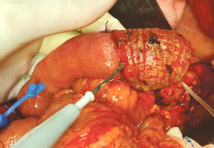 The everted mucosa (A) was electrocauterized for more favorable attachment to pancreatic remnant (B). 유발하여췌장과의유착을형성할것으로기대하기때문이다. Fig. 3과같이공장점막과췌장절단면과봉합을시도하였다.