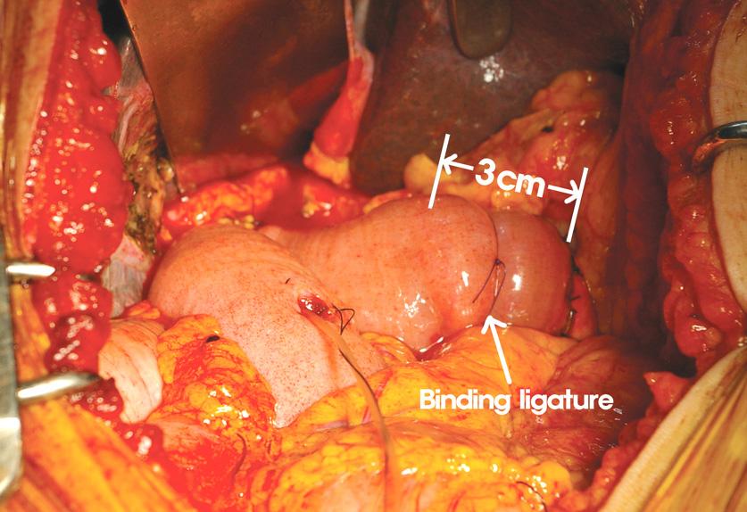 A binding ligature using an absorbable material was applied on the midpoint of the jejunal segment containing pancreatic stump (B). 은수술용기구가통과될정도로너무느슨하지도않으면서너무세지도않게하였다.