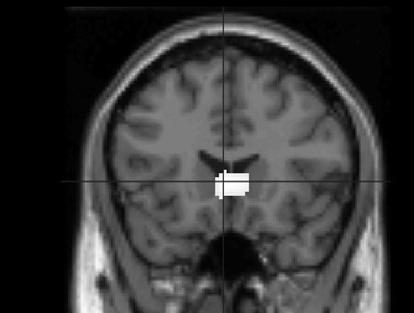 Empathy:intraparietal sulcus, mood monitoring. a:frontopolar cortex. b:subgenual prefrontal cortex and temporal pole. c:entorhinal cortex. d:inferior temporal gyrus.
