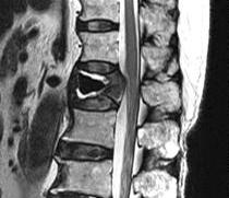 spinal canal and neural compression at the level of L1. 골정 (osteotome) 과큐렛을이용하여제거하였다.