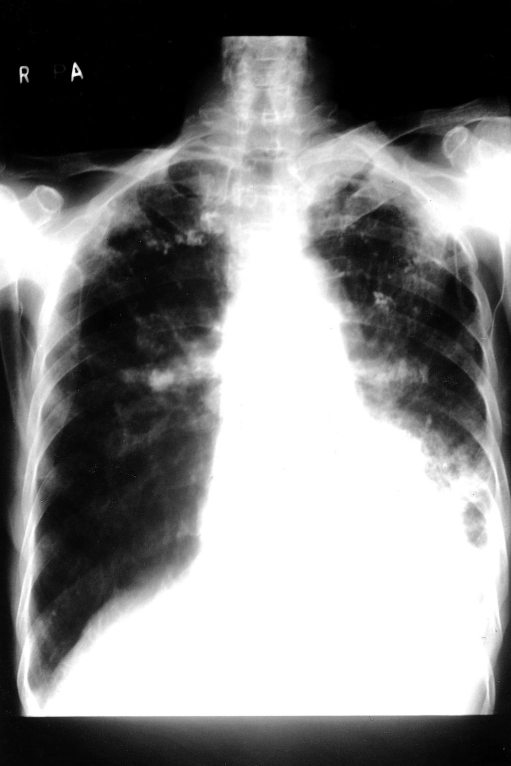 Bo Ra Yun, et al : A case of metastatic large cell carcinoma of the duodenum from the lung 에서 치료를 받았으나, 호흡곤란이 심해지고 식욕부진 전산화단층촬영(CT )상 좌하폐엽에 약 6 5cm 크기의 및 소화 불량이 발생하여 본원으로 전원되어 입원하였 변연이 불규칙하고 분엽상을 보이는