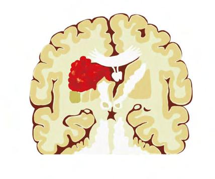 뇌졸중의종류 뇌졸중의종류는크게뇌경색과뇌출혈로나눌수있습니다.