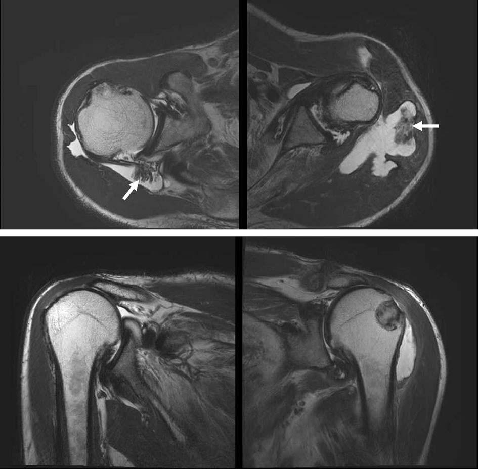 대한견 주관절학회지제 10 권제 1 호 A B Fig. 3. (A) Preoperative axial MRI of both shoulders show diffuse synovial proliferation with deltoid muscle infiltration and pigmented soft tissue mass (arrow).