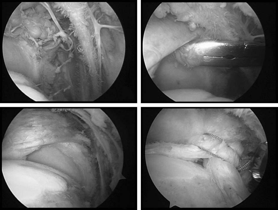 (D) Arthroscopic photograph showing deltoid muscle infiltration at the subdeltoid bursa area. D A B C Fig. 4.
