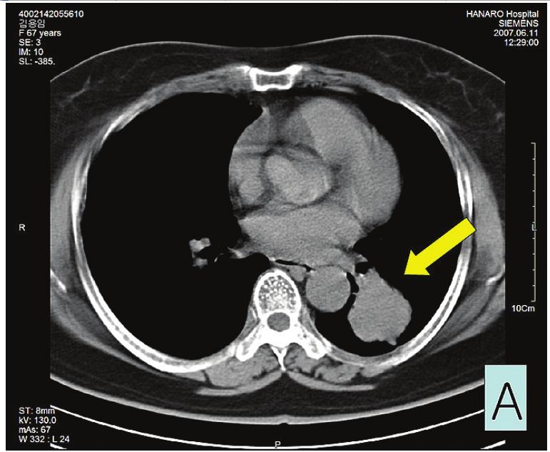 A. Non-small cell carcinoma(x100). Fig.