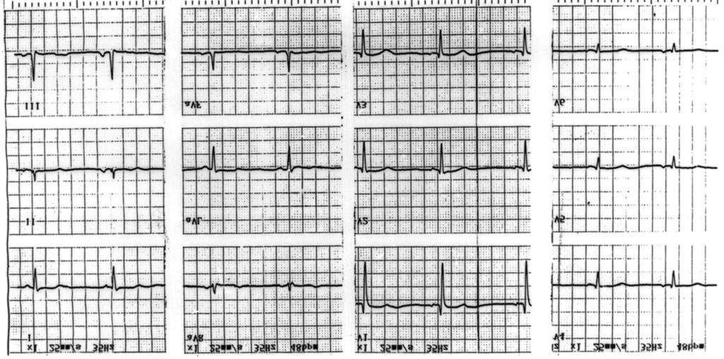 Fig. 1. Electrocardiogram showing the classic changes of uncomplicated mirror-image dextroardia.