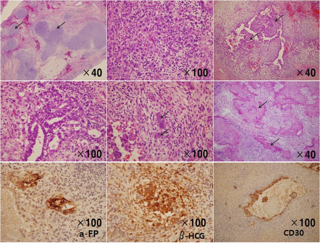Hae-Kyung Kim, et al. Ovarian mixed germ cell tumor in a patient with 45,X/46,X,+mar mosaic Turner s syndrome A B C D E F G H I Fig. 5.