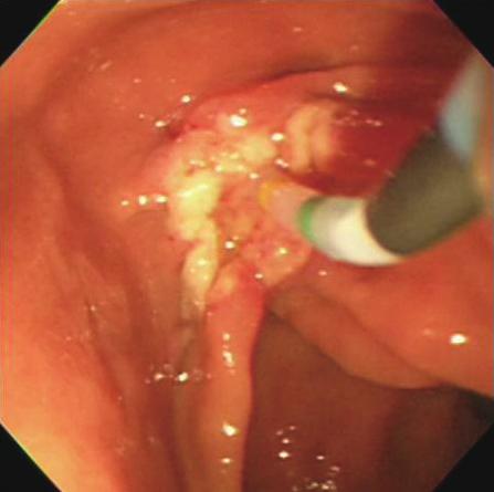A B C D E F Fig. 3. Endoscopic papillectomy.