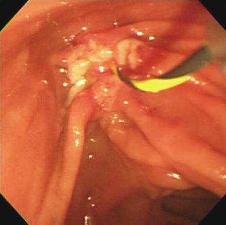 (B) Normal appearance of common bile duct and