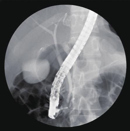 (F) Placement of plastic stent in main pancreatic