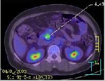Young Joo Jang, et al. Autoimmune pancreatitis, CBD cancer Figure 2. PET-CT showed a hypermetabolic lesion (arrow) in the distal CBD.
