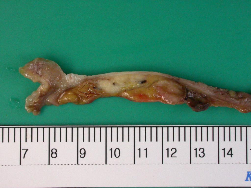 Gross findings show that it measured 7 cm in the CBD. The appearance of the bile duct was unremarkable. B Figure 4.