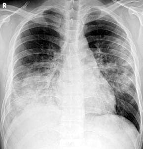 lobar consolidation in right lower and left upper lung field