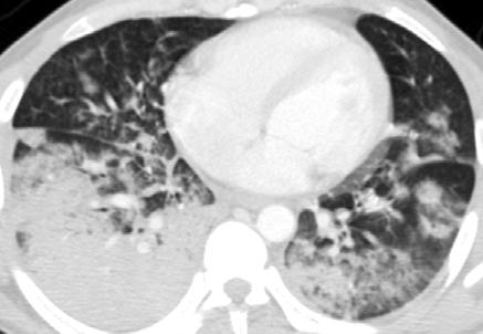 in right lower lobe, with pleural effusion (B).