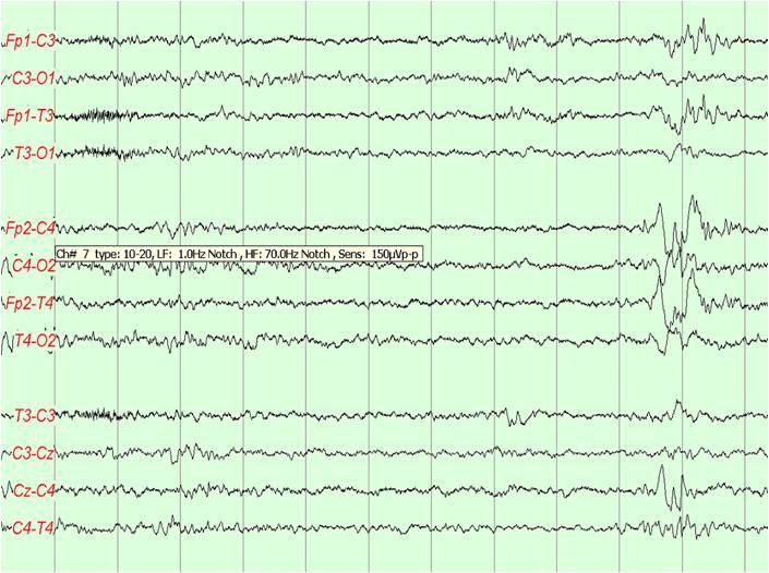 A B C Figure 1. Abnormal background of interictal EEG, examples. (A) Trace discontinua pattern. (B) Pathological frontal sharp transients. (C) Burst-suppression pattern. 시사하는보고가알려져있다.