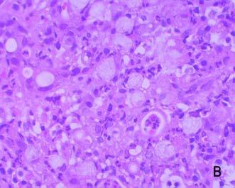 A (H & E, 200) Squamous cell carcinoma shows the proliferation of the squamous cell with atypical chage. B (PAS, 400).