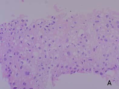 PAS positive eosinophilic granular material(arrowhead) filled in the grandular cell is shown. 발병변이의심할만한소견은없었다.