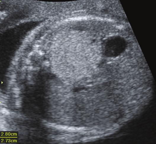 Transverse sonogram of the fetal chest shows a multicystic lung mass of congenital cystic adenomatoid malformation (white arrow). H, heart. 2.