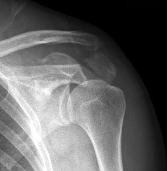 images show triple fracture involving the proximal portion of