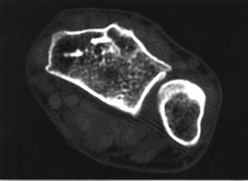 Two perpendicular lines are drawn in the volar and dorsal margins of the sigmoid notch. The ratio of length UD: is calculated. Fig. 2. The DRUJ CT scans of patients with healed distal radius fracture.