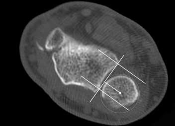 256 김종필ㆍ박민종 Volar Volar Dorsal Dorsal Fig. 4. Type instability of the DRUJ. CT scan demonstrates abnormal dorsal subluxation of the ulnar head in supination.