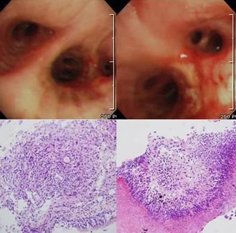 - Hye Ok Kim, et al. Wegener s granulomatosis suspected as lung abscess - A C B D Figure 3.