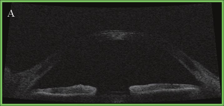 장동호외 : 백내장수술과앞방내계측치의변화 Figure 3. Anteior segment optical coherence tomography (OCT) image before cataract surgery (A), postoperative 1 week (B), postoperative 1 month (C).