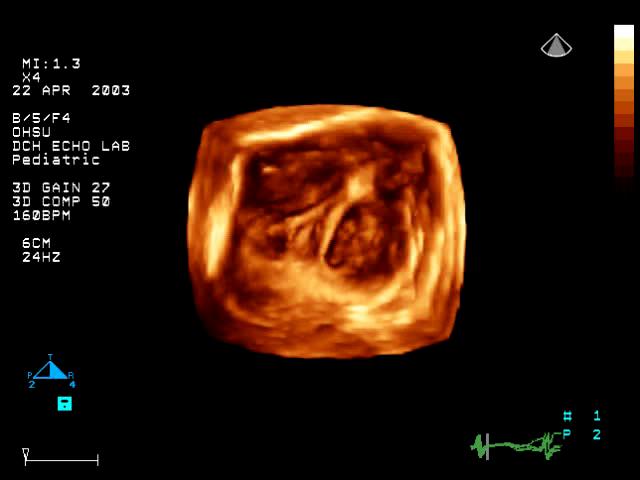 3D image 출처 : 필립스 Dysplastic tricuspid valve (En face view tricuspid and mitral valves)