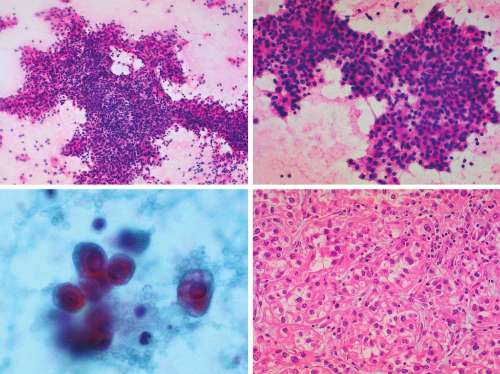 오영륜 : 전이성 폐종양의 세포소견 C D Fig. 5. Metastatic renal cell carcinoma.