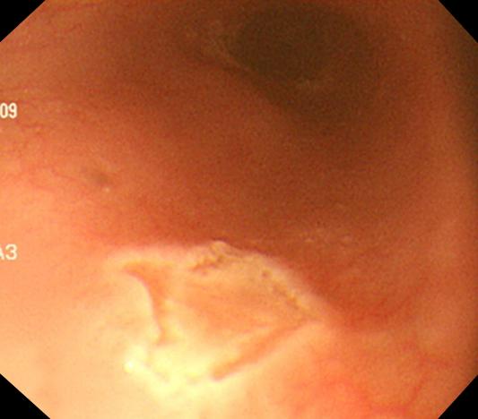 Endoscopic findings of esophagus. (A) On admission, the yellowish and greenish plaque diffusely coating distal and mid-esophageal mucosa was shown.