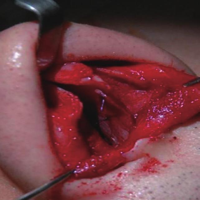 The excess portions of the caudal strut were overlapped and sutured (C).