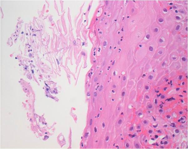 Hyun Ah Kim, et al. HSV, CMV and candidal esophagitis in an AIDS patient A B Figure 2. (A) Pathologic examination of the esophageal biopsy shows candidal hyphae invading the squamous epithelium.