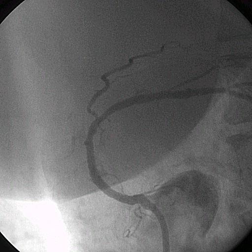 Fig.. After two stent grafts (.