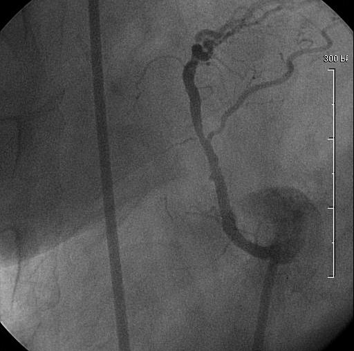 significant residual stenosis. Fig. 4.