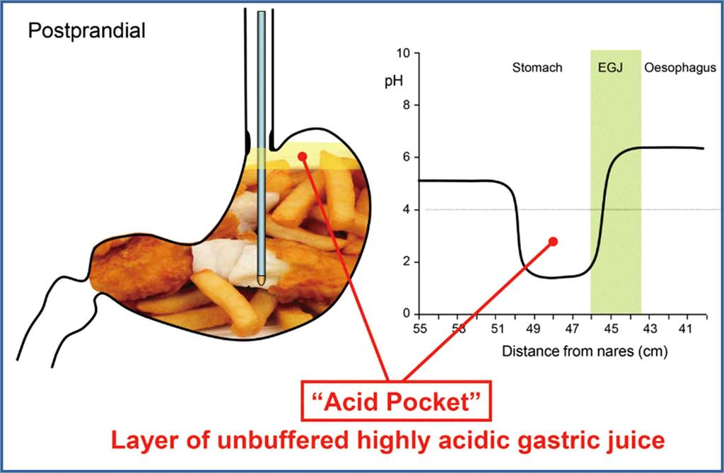 따라서 acid pocket 이횡경막보다아래쪽에위치한경우 TLESR 의 10% 에서산역류가일어나지만, acid pocket 이횡경막보다위쪽에위치한경우 TLESR 의 80% 에서산역류가 일어난다.