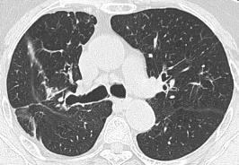 volume loss, pleural thickening or calcification, fibrotic linear opacity,