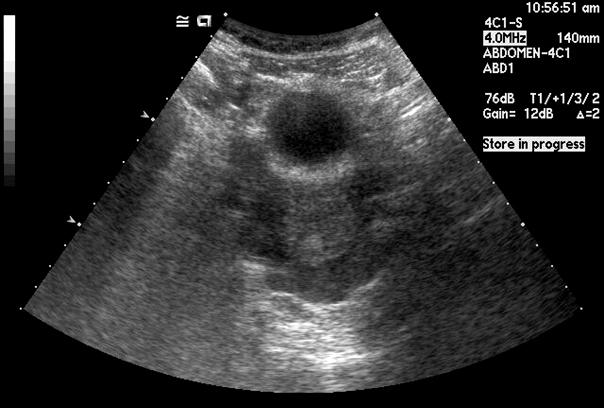 Operative finding of hepatic capsular inflammation with adhesion of capsule to peritoneum. Fig. 2.