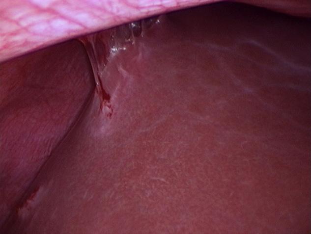 . Operative finding of pelvic inflammation with adhesion of uterus to ileum.